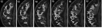 Breast lesion segmentation results